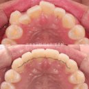 이미지플러스치과교정과치과의원 | 발치 없이 하는 심한 덧니 비발치 교정 [부산교정치과]