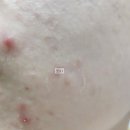 (내돈내산) 아크로패스 큐어 패치 / 구매부터 사용 후기까지 / 트러블 고민 ㅜㅜ / (사용 후 후기추가!)