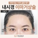 이마거상술 후기, 가격, 붓기, 골종제거 사례!