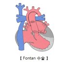 양방단실유입증[Double inlet ventricle소아청소년질환, 순환기질환] 이미지