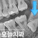 스타치과기공소 | 행신동치과 매복사랑니 당일발치 | 서울오늘치과 20대 여성 환자 사랑니발치후기