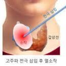 갑상선 결절 중재치료[interventional treatment of thyroid nodular disease] 이미지