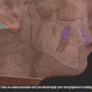 우리교정치과기공소 | 가평교정치과, 심하게 회전된 상악 전치 문제가 있던 환자 후기(ft. 치간 삭제)