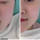 남양주 덕소 예신 피부관리는 LPG엔더몰로지 리얼 후기 (타임동안뷰티센터타임그루답터포맨)