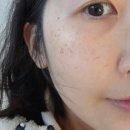 제너리스의원 광명철산 | 광명 철산 피부과 기미 색소침착 상담 후기