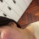 추병원 | 리쥬란 내돈내산 1일차 후기 aka 마취에 진심인 이병원.. 강-추