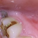 리볼리치과의원 | 오리역 치과 추천, 누워있는 사랑니 발치 성공 후기 (리볼리치과의원)