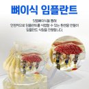 역삼동치과 임플란트 뼈이식 중요한 이유는?