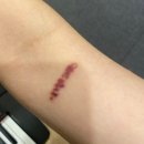 디앤써피부과의원 | 미니 레터링 타투 제거 1~5회차 후기 / 디앤써피부과의원 (경과 사진, 통증, 비용)