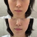 로데오사우나 | 강남 압구정로데오역 피부과 튠라이너 15분 3회 내돈내산 솔직후기 *1회차리뷰