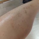 김수철한의원 | [공지] 습진+아토피+알러지+스테로이드 부작용(리바운드) 한의원에서 고쳤어요~^^(인천 김수철 한의원)