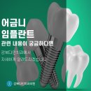 미아사거리역 치과, 어금니 임플란트의 다양한 방법 알아보기 이미지