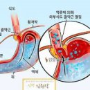 명치 위 통증 의심해 보아야 할 은 이미지