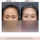 대전성형외과 | 60대 눈썹하거상·하안검리프팅·내시경이마거상 수술 전후 후기