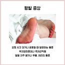 평발 치료법 여기서 확인해보세요 이미지