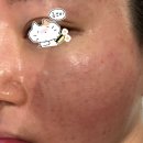 수화 헤어톡 | 발산역 피부과 쥬베룩 안 아프게 맞기 꿀팁 내돈내산 스킨부스터 3개월차 변화 사진까쥐이