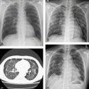 파라인플루엔자 감염증 (Parainfluenza Infection) 이미지