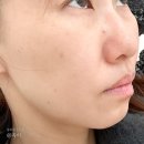 서현한의원 | 서현역 한의원, 얼굴 목 점제거 후기! 눈가 비립종까지 싹 밀고 온 내돈내산 찐후기