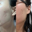 창원피부과 셀엑소좀 1회만으로 좁쌀여드름 관리 한 후기