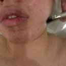 지족로 | [지족동 에스테틱] 피지 박멸! 오르네 스킨타이닝 닥토필 관리 솔직 후기 (ft. 파이토신 V2)