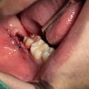 탕정이앤정치과의원 | [아산 사랑니 발치] "턱이 아픈 게 사랑니 때문?" 사랑니와 턱관절 건강의 밀접한 상관관계