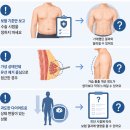 시그널성형외과의원 | 부산 여유증 후기, 수술 전에 알아야 할 것들이 생각보다 많습니다