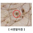 사면발이증[Pediculosis pubis] 감염성 질환, 신장비뇨기질환, 피부질환 이미지