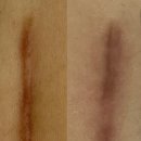 문화아파트 맞은편 구덕운동장 입구 | 동대신동흉터관리 비체스킨앤바디랩에서 관리하세요 흉터관리 솔직후기,주차,가격