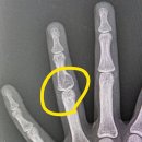 123스텝업병원 | 손가락 내연골종 enchondroma 수술후기 (feat 천호역 정형외과추천)