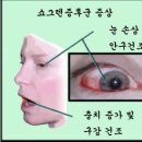 쇼그렌(Sjögren) 증후군(syndrome) 이미지
