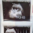 알메디파크 | 임신 12주 차, 점점 더 심해지는 입덧,차멀미, 1차 기형아 검사, 대구여성메디파크 산후조리원 예약