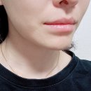 에코라인의원 | 신사 :: 레브치과 이갈이 보톡스 2주차 후기 / 이갈이보톡스 후기 / 전후사진 有