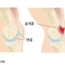 오른쪽 왼쪽 무릎 구부릴때 통증 원인 이미지