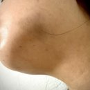 다다치과의원 | 매복사랑니 3개 발치 후기｜통증·회복기간·주의사항 정리