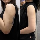 팔평집 | 영등포 지흡주사 한달후기 | 팔지흡 붓기 빼는 법