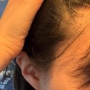 자모스프링여성의원 | [헤어라인교정후기] 11. 수술 후 10개월차 후기 - 재수술 할지도??