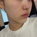 누리고나누고부산센터 | 부산 서면 티타늄리프팅 잘하는곳 심부볼 팔자주름 1주차 후기 | 효과, 부작용, 통증, 당일붓기