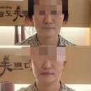 여수 피부관리 써마젯 고주파 리프팅 오늘도 미쁘다 추천