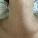 유경험자의 편평사마귀 목&amp;상반신(가슴, 배) 레이저 제거 후기(내돈내산ㅠㅠ)(부산!)