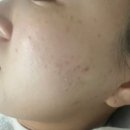 이마트24대구본점 | 동성로피부관리 ㅣ 여드름흉터 애프터필 후기 가꾸다 대구본점