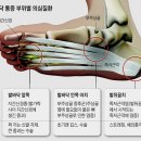 러너복싱 | 🦶 족저근막염 치료 후기 – 러너 현실 회복 기록