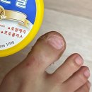 푸스플레게 샵 다니면서 내성발톱 치료 후기 (with 완치가 머지않아)