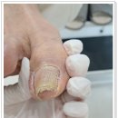 울산 발톱 무좀 전문샵 이용 후기: 아버지의 행복한 변화!