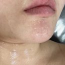 프린세스 | [대전 지족동 에스테틱 프린세스] 아토피 +극건성 피부 관리 후기