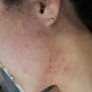 위드 굿 스킨(WITH A GOOD SKIN) | 송파 여드름관리 위드굿스킨 - 20년 경력 원장님 손길로 받은 압출진정재생 후기
