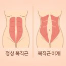 테이핑 및 마사지 이완운동 | [공지] 흑석동 필라테스, 복직근이개 3개월 안에 잡아야 하는 이유