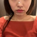 w-30 | 강남 볼뉴머 30대 리프팅 후기 (가격, 통증, 효과, W클리닉)