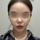 프라임 | 울쎄라피 프라임 후기, 시술 후 어떤 변화가 있을까?(ft. 울쎄라 차이)