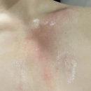 보나약국 - 청주시 서원구 모충로 93 | 뜨거운 물에 데인.. 표재성 2도 화상 / 물집 흉터 치료 및 관리 리얼 후기 + 보험 청구