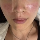 평안한의원 | 강남 여드름한의원새살침 여드름흉터자국 치료후기